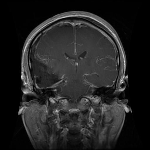 Contoh Glioma