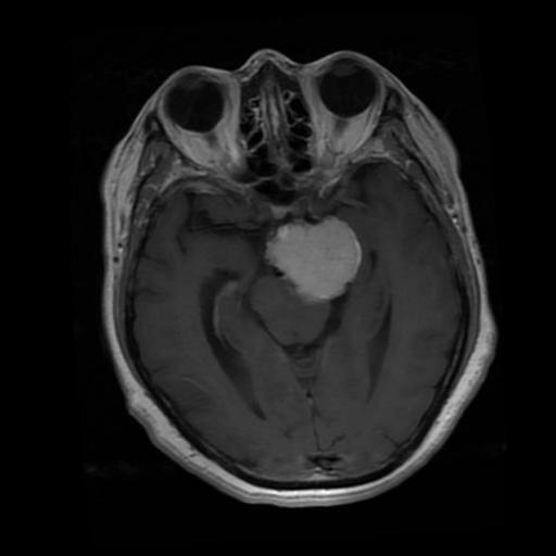 Contoh Meningioma